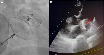 Case Report: Successful retrieval of a migrated left atrial appendage occluder through the synergistic use of a guidewire and a gooseneck snare